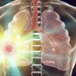 伏美替尼（Firmonertinib）最新研究：EGFR L858R肺癌患者的希望与疗效深度解析