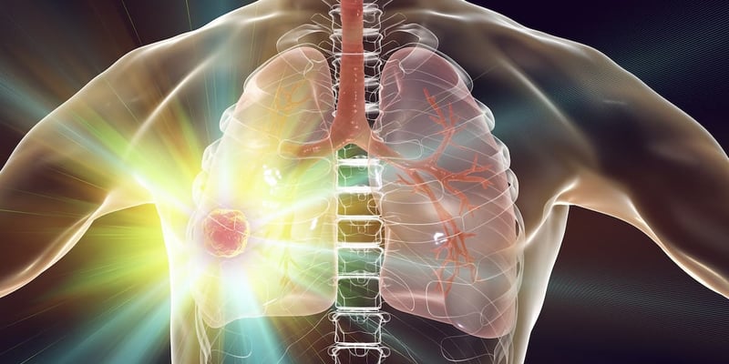 伏美替尼（Firmonertinib）最新研究：EGFR L858R肺癌患者的希望与疗效深度解析