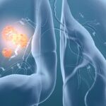 KRAS肺癌靶向治疗新进展：Sotorasib联合方案试验终止，新药VS-7375（G12D）疗效数据与获取渠道