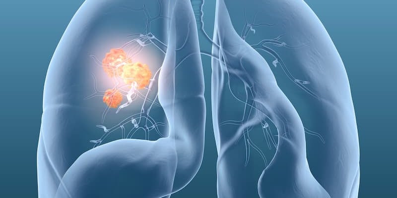 KRAS肺癌靶向治疗新进展：Sotorasib联合方案试验终止，新药VS-7375（G12D）疗效数据与获取渠道