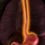 胃癌/胃食管结合部腺癌新突破：CLDN18.2靶向药佐妥昔单抗联合免疫化疗显著延长PFS，附海外购药指南