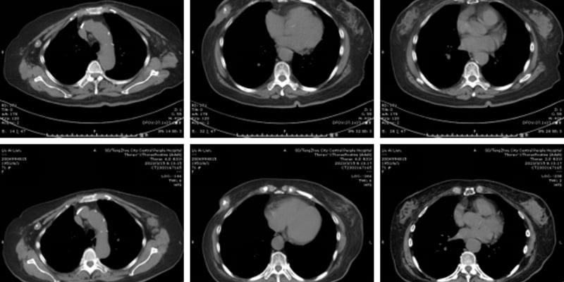 HER2阳性乳腺癌多线治疗：8年抗癌路，德曲妥珠单抗等新药如何延长生命？