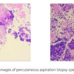 小细胞肺癌免疫治疗效果悬殊？揭秘TMB、PD-L1与基因突变的关键密码