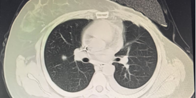 HER2低表达晚期乳腺癌治疗新希望：DS8201疗效、副作用与购药指南