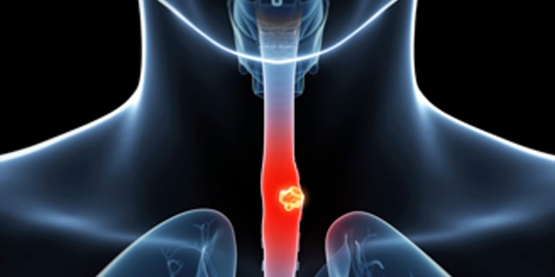 食管鳞癌治疗新突破：新辅助放化疗与辅助治疗，患者如何选择？最新研究深度解读