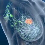 HER2阳性乳腺癌治疗新趋势：Phesgo皮下注射输注系统获FDA审查，提升患者舒适度与效率