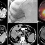 《CA》顶刊解读：肝癌消融与栓塞治疗怎么选？2025最新指南深度解析