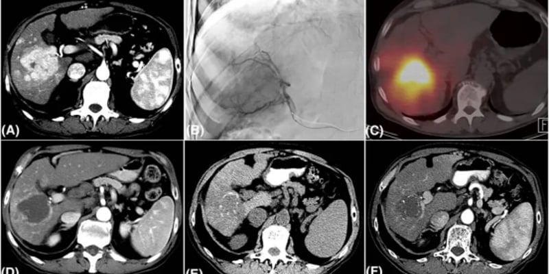 《CA》顶刊解读：肝癌消融与栓塞治疗怎么选？2025最新指南深度解析