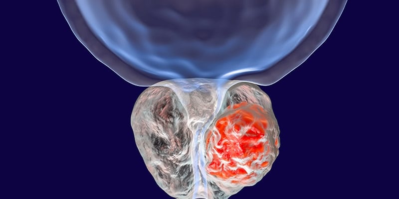 ESMO最新前列腺癌指南深度解读：早期诊断、复发监测与治疗策略全解析