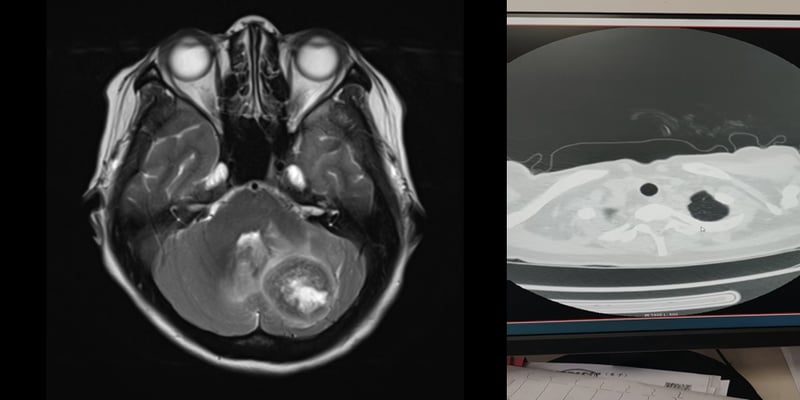 晚期HER2阳性乳腺癌脑转移不再绝望：德曲妥珠单抗真实案例与专家治疗方案