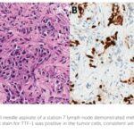 PDGFRA重排髓系肿瘤与非小细胞肺癌：双癌患者新辅助免疫+伊马替尼，如何实现病理完全缓解？