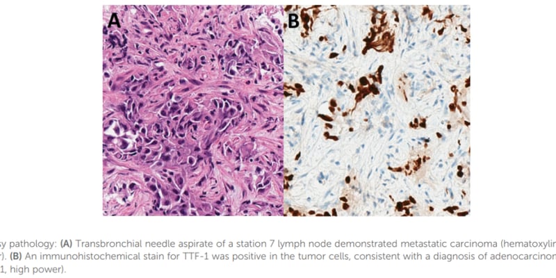 PDGFRA重排髓系肿瘤与非小细胞肺癌：双癌患者新辅助免疫+伊马替尼，如何实现病理完全缓解？
