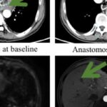 晚期胃癌治疗新希望：IMC002 CAR-T疗法突破性进展，66.7%缓解率与卓越安全性解析