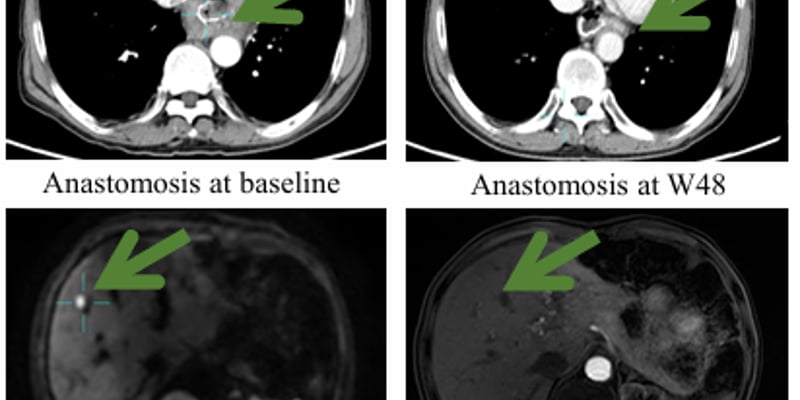 晚期胃癌治疗新希望：IMC002 CAR-T疗法突破性进展，66.7%缓解率与卓越安全性解析
