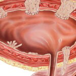 膀胱癌新希望！Nogapendekin alfa (Anktiva) 获批，BCG无效患者福音，疗效、副作用与获取渠道全解析