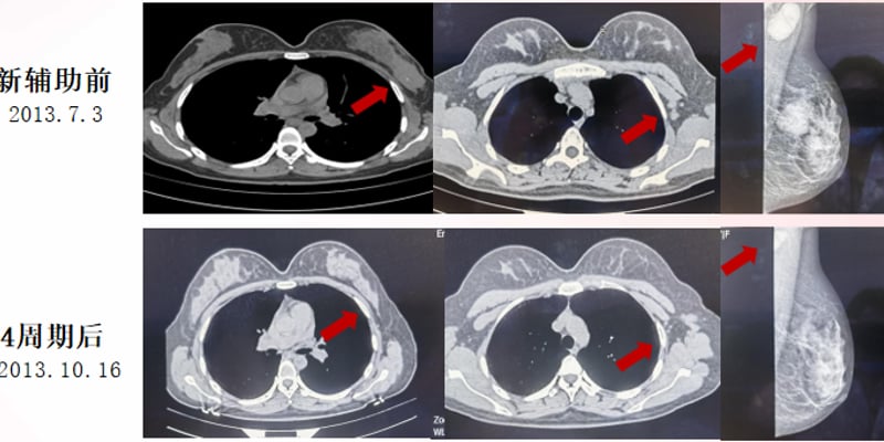 28岁乳腺癌患者12年抗癌奇迹：HER2阳性复发转移，T-DXd等新药如何带来生机？