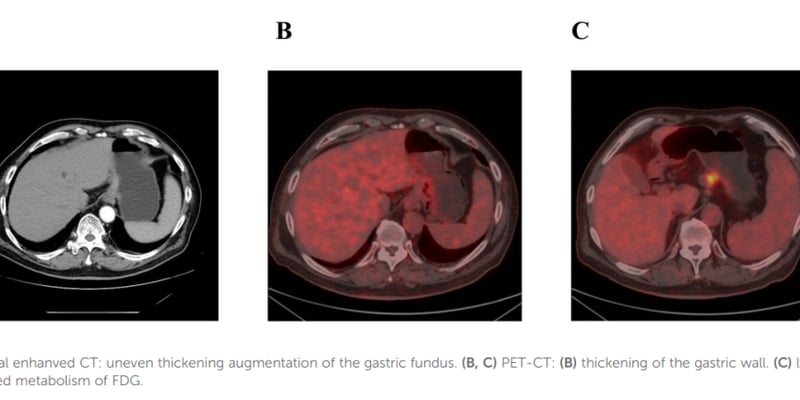 罕见三重癌症共存：华氏巨球蛋白血症、HER2胃癌与GIST的诊断与泽布替尼应用解析