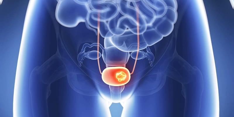 膀胱癌无创诊断新希望：尿液生物标志物miR-93-5p/miR-191-5p精准识别分子亚型