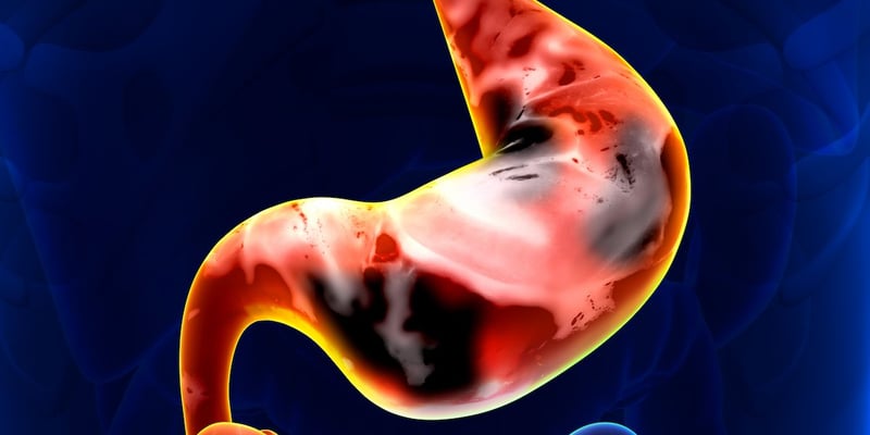 卡度尼利单抗：PD-L1低表达胃癌/胃食管结合部癌一线治疗新突破，生存期显著延长！