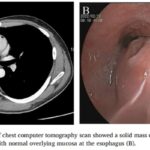 SDH缺陷型胃肠道间质瘤（GIST）罕见食管病例解析：诊断标准与靶向药最新治疗方案