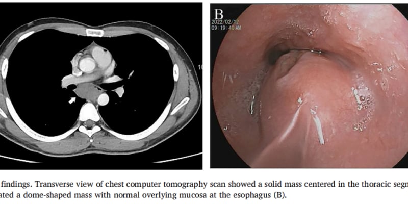 SDH缺陷型胃肠道间质瘤（GIST）罕见食管病例解析：诊断标准与靶向药最新治疗方案