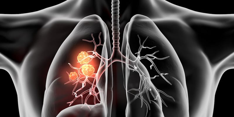 非小细胞肺癌新希望：Nogapendekin Alfa联合免疫治疗，显著提升免疫力，延长患者生存期！