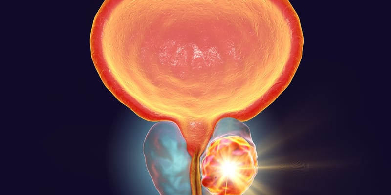转移性去势抵抗性前列腺癌新希望：AB001 α放射性配体疗法ARTISAN临床试验进展解读