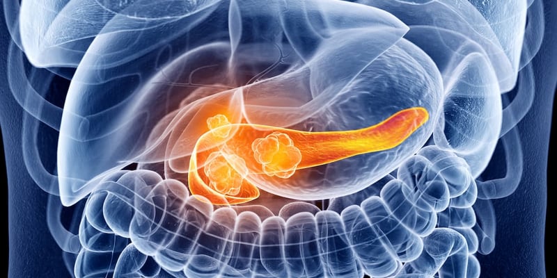 胰腺癌治疗新进展：TACTOPS多抗原T细胞疗法，安全可行带来新希望