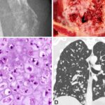 软骨肉瘤新发现：BCOR突变预示疾病侵袭性？深度解读与治疗展望