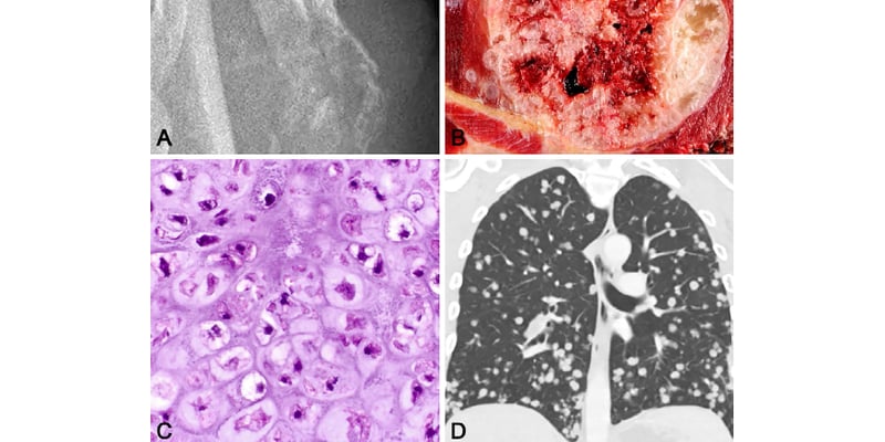软骨肉瘤新发现：BCOR突变预示疾病侵袭性？深度解读与治疗展望