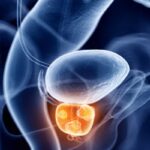 前列腺癌治疗新突破：冷却激光局灶治疗（ProFocal）早期结果揭示局部控制率高，副作用更少！