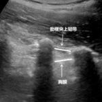 白血病治疗新突破：鞘内泵植入术告别反复腰穿痛苦，精准防治中枢侵犯
