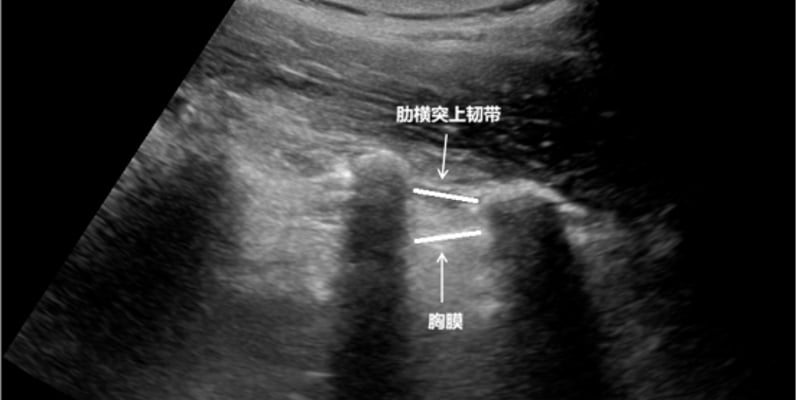 白血病治疗新突破：鞘内泵植入术告别反复腰穿痛苦，精准防治中枢侵犯