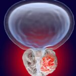 复发性前列腺癌治疗新突破：局灶治疗VS手术，生存率与并发症深度解析