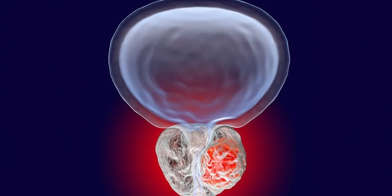 复发性前列腺癌治疗新突破：局灶治疗VS手术，生存率与并发症深度解析