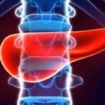 胰腺癌新辅助治疗突破：纳武利尤单抗联合FOLFIRINOX深度解析与用药指南