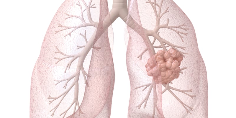 ASCO最新指南：晚期非小细胞肺癌（NSCLC）治疗新策略，免疫+靶向方案深度解析