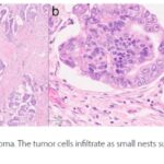 结直肠微乳头状癌深度解析：侵袭性更强？最新研究揭示基因突变与治疗策略