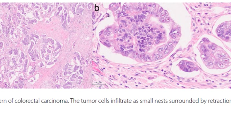 结直肠微乳头状癌深度解析：侵袭性更强？最新研究揭示基因突变与治疗策略