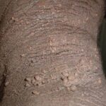 警惕！罕见黑棘皮病与EGFR突变：靶向药奥希替尼、厄洛替尼逆转病情防癌变