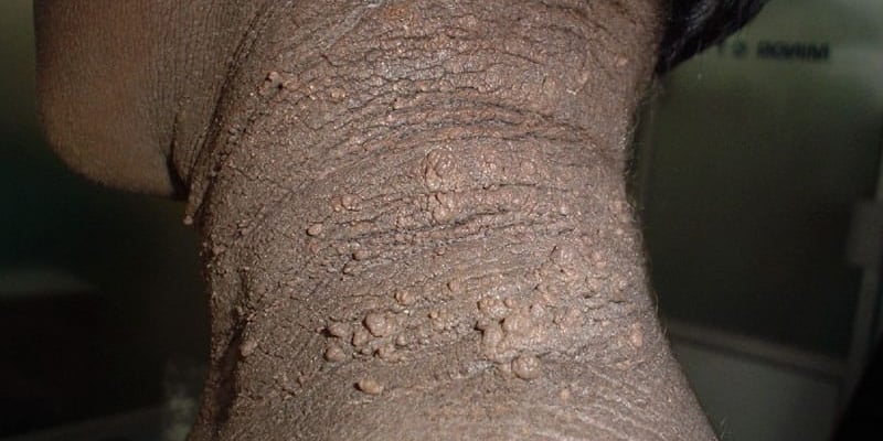 警惕！罕见黑棘皮病与EGFR突变：靶向药奥希替尼、厄洛替尼逆转病情防癌变