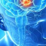 FG001获FDA批准！高级别胶质瘤精准手术新希望，助力肿瘤可视化切除