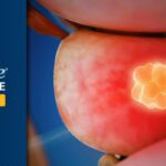 BRCA/ATM突变转移性前列腺癌治疗新突破：奥拉帕利联合阿比特龙，超长生存期带来希望