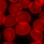 BPDCN新药突破！Pivekimab Sunirine一线治疗疗效持久，副作用可控，如何选择？