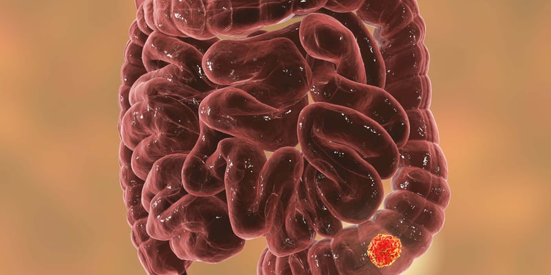 重磅！II/III期结直肠癌辅助化疗，3个月与6个月疗效无显著差异？SCOT研究终极揭秘