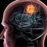 儿童高风险髓母细胞瘤治疗新突破：靶向脂质代谢，降低毒性新希望