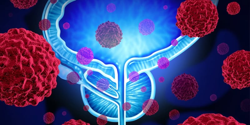 前列腺癌放疗：警惕泌尿生殖系统晚期副作用，新研究揭示风险与应对策略