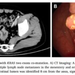 结直肠癌KRAS双突变G13D+Q61H：为何治疗更棘手？NGS检测与靶向耐药深度解读