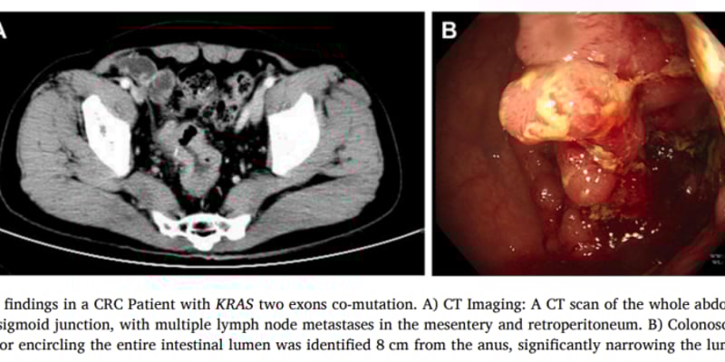 结直肠癌KRAS双突变G13D+Q61H：为何治疗更棘手？NGS检测与靶向耐药深度解读