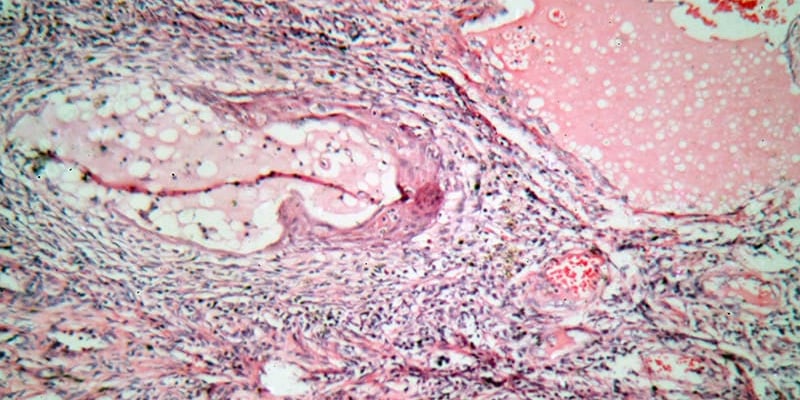 突破传统：月经血筛查HPV，居家自检有望终结宫颈癌“尴尬”与“漏诊”